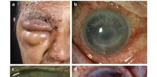 HEALTH: How to beat shingles, a skin disease