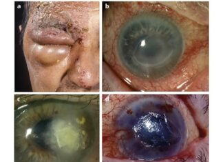 HEALTH: How to beat shingles, a skin disease