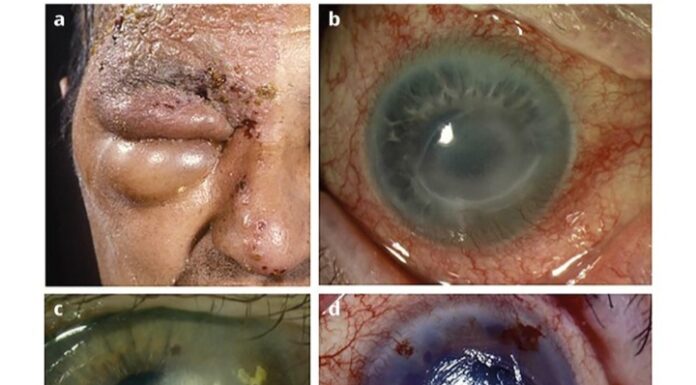 HEALTH: How to beat shingles, a skin disease