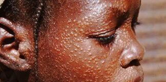 HEALTH: DNDi’s new drug to ease Kala-azar woes