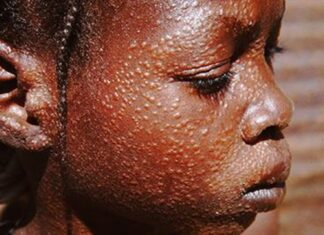 HEALTH: DNDi’s new drug to ease Kala-azar woes