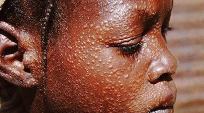 HEALTH: DNDi’s new drug to ease Kala-azar woes