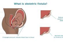 An illustration of how obstetric fistula occurs. Worryingly, a whopping 2 to 3 million women worldwide have fistula, according to data by UNFPA. ILLUSTRATION/Catherine Hamlin Fistula Foundation.