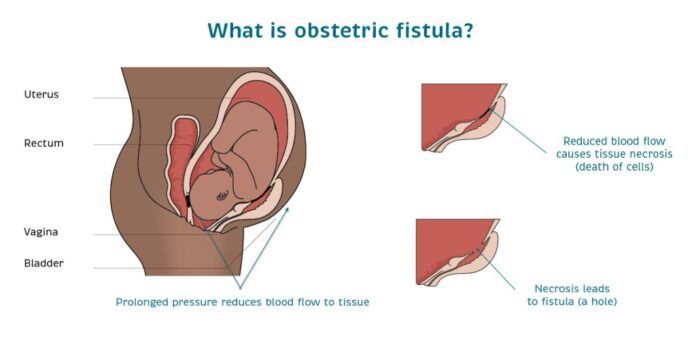 An illustration of how obstetric fistula occurs. Worryingly, a whopping 2 to 3 million women worldwide have fistula, according to data by UNFPA. ILLUSTRATION/Catherine Hamlin Fistula Foundation.
