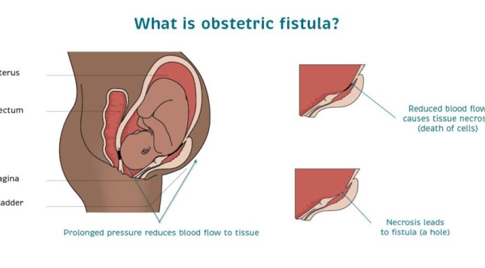 Untold tales of heroines battling fistula; pregnant women’s dreaded nightmare An illustration of how obstetric fistula occurs. Worryingly, a whopping 2 to 3 million women worldwide have fistula, according to data by UNFPA. ILLUSTRATION/Catherine Hamlin Fistula Foundation.